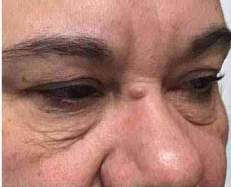 Morpheus8 Before