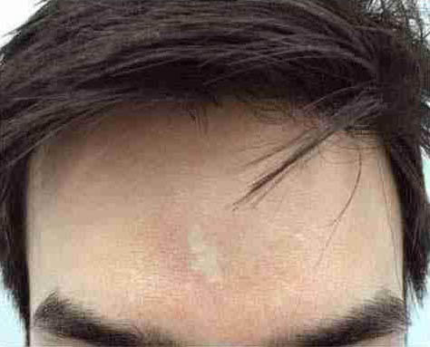 Morpheus8 Before