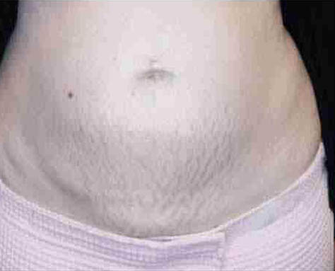 Morpheus8 Before