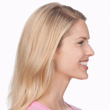 Botox Before