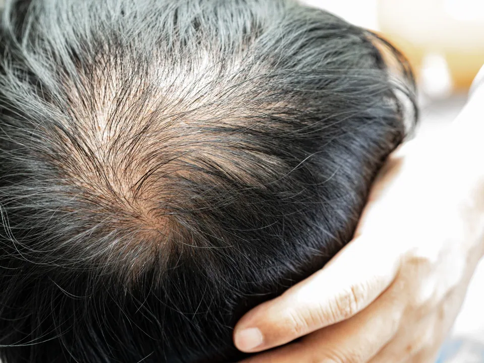 Laser Hair Rejuvenation