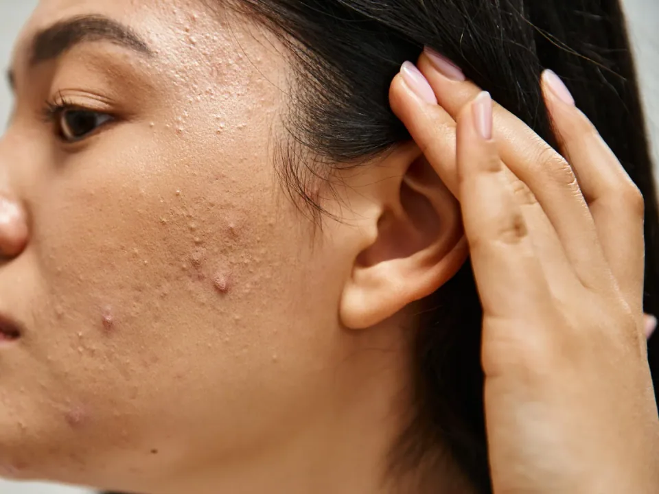 Microneedling
