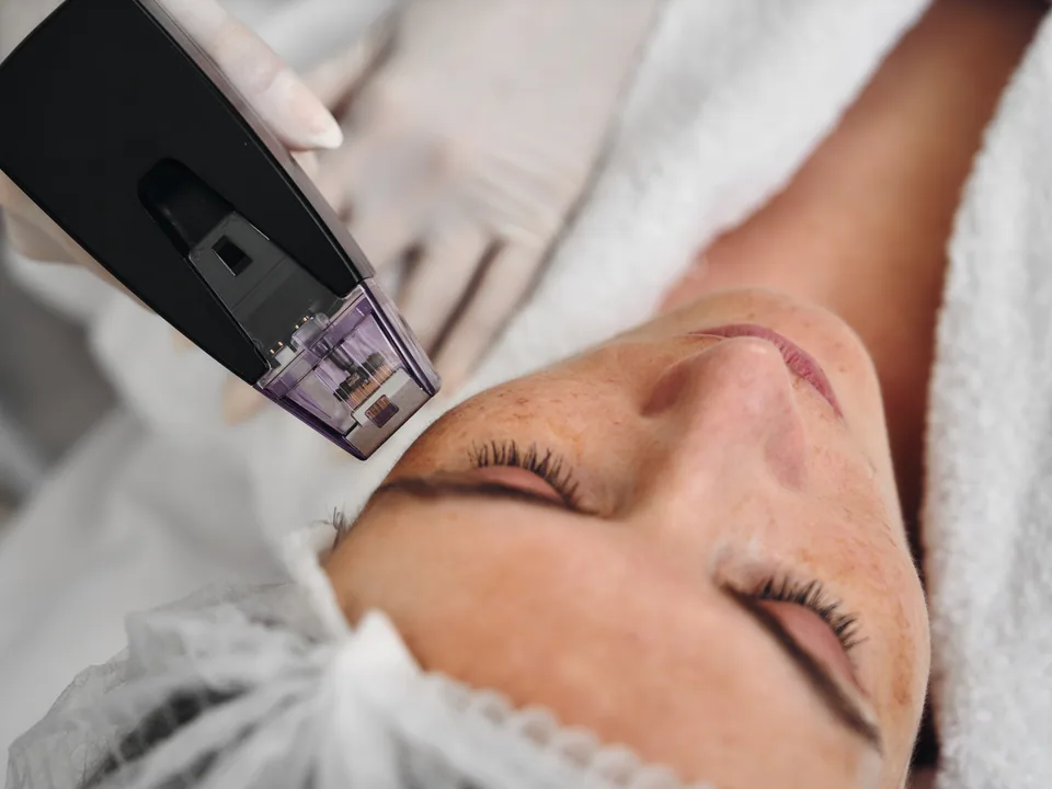 Morpheus8 Skin Tightening Treatment