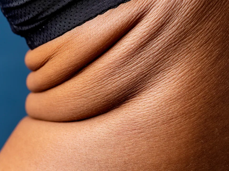 Radio Frequency Body Tightening: Non-Surgical Skin Tightening Treatment