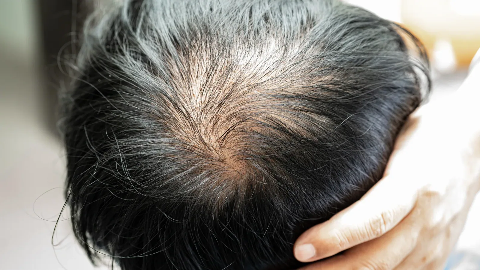 Laser Hair Rejuvenation treatment