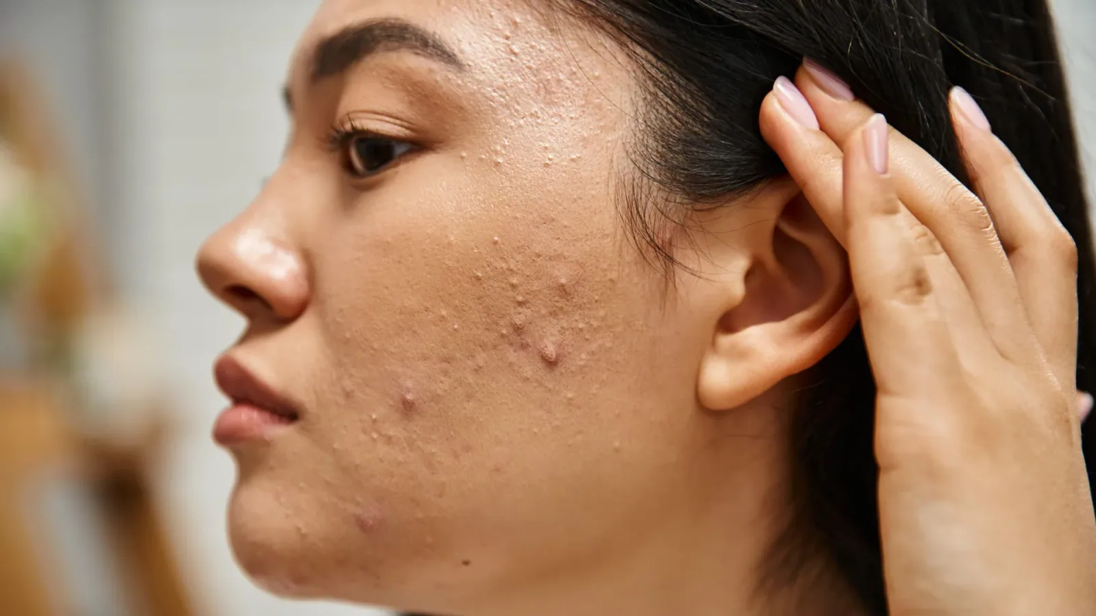 Microneedling treatment