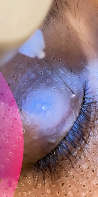 Plasma Eye Lift