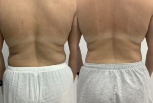 Fat Freezing of Love handles