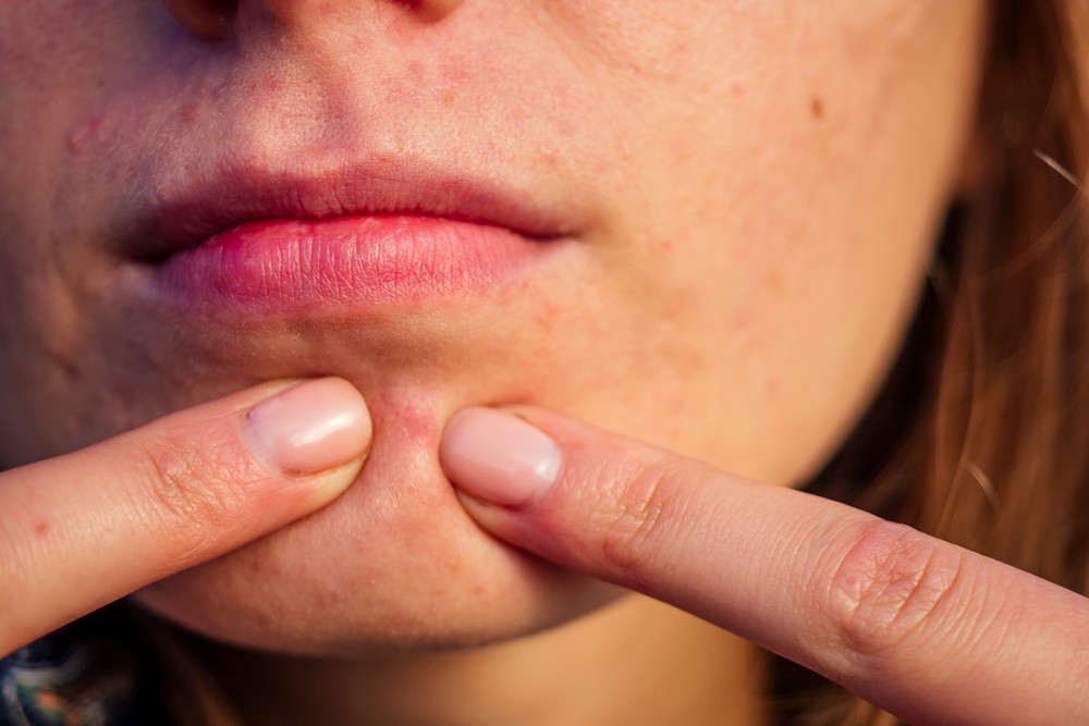 Spots vs Acne