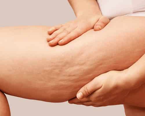 Cellulite Reduction Treatment