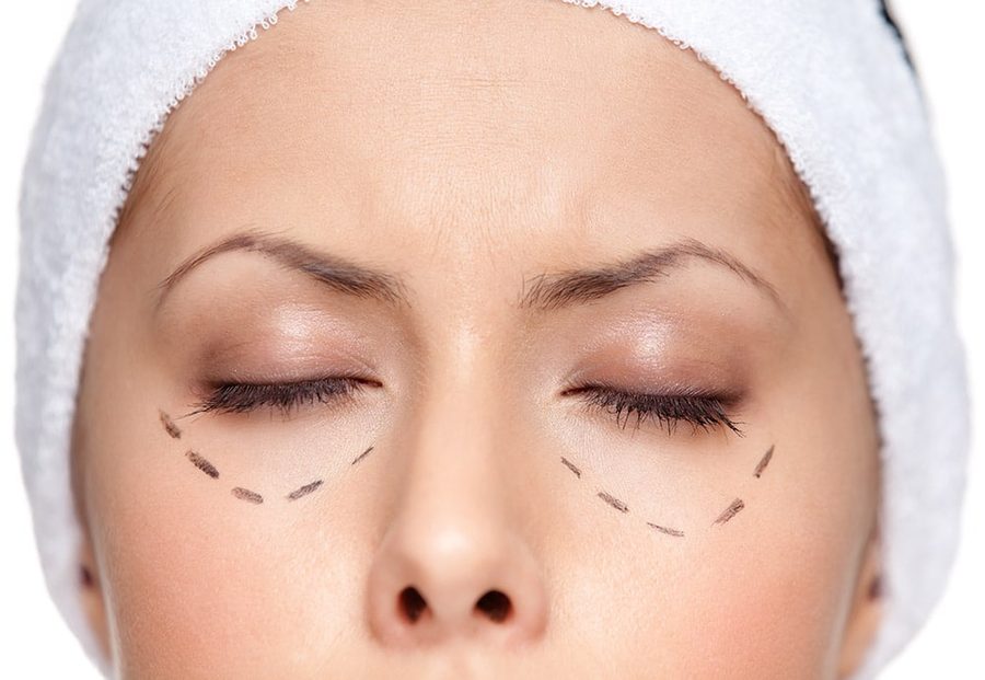 Eyelid Surgery - Plasma Eye Lift