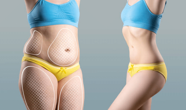 Fat Freezing in Bournemouth