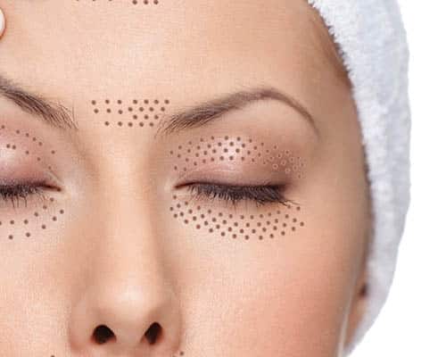 Plasma Eye Lift in Dubai