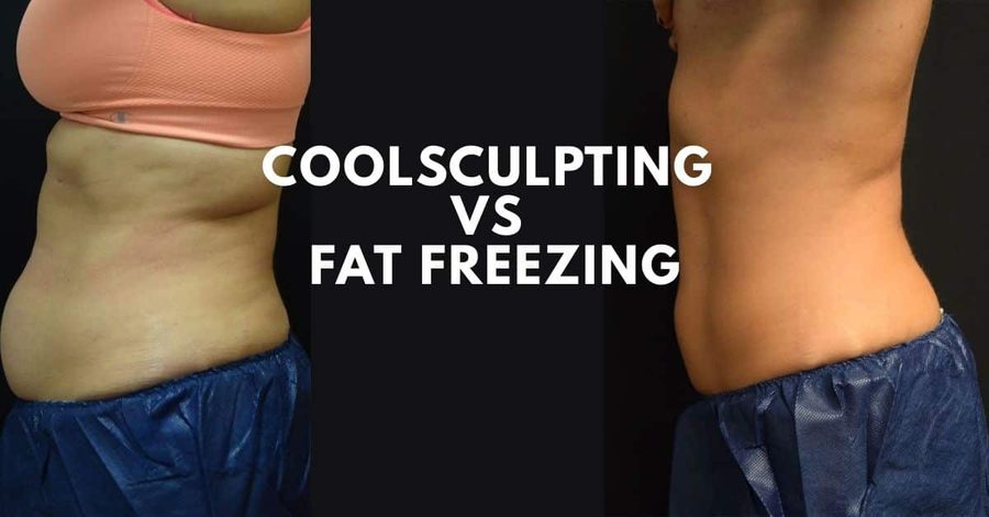 CoolSculpting vs Fat Freezing