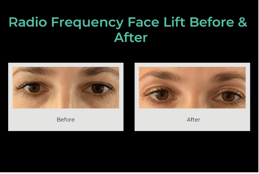 Radio frequency face lift in Southampton