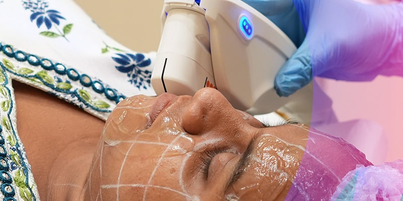 HIFU Facelift
