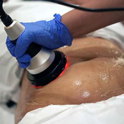 Ultrasound Cavitation
