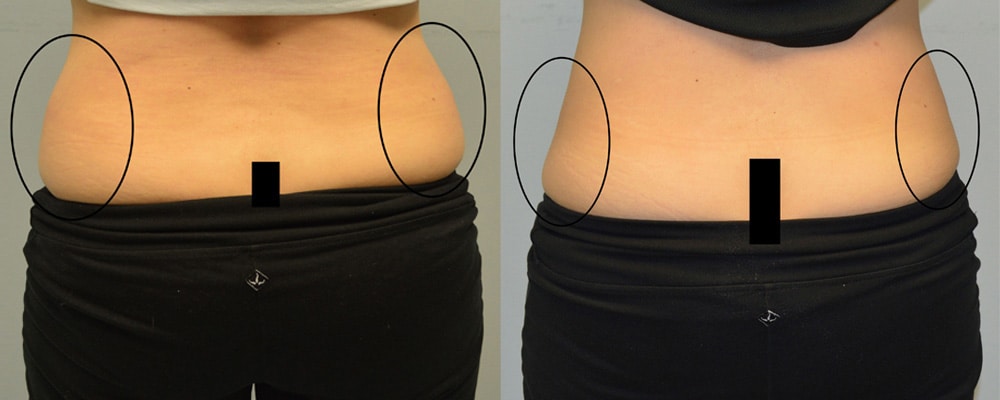 A 12 week journey showing Sarah T Love Handles Transformation using Fat Freeze