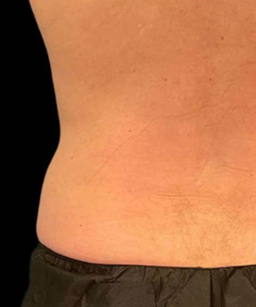 cryolipolysis - After Fat Freezing Before After