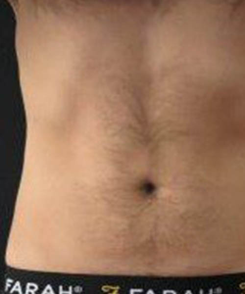 cryolipolysis - After Fat Freezing Before After