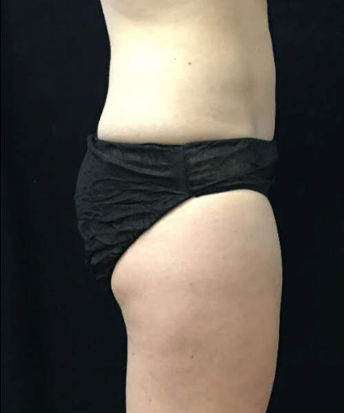 cryolipolysis - After Fat Freezing Before After