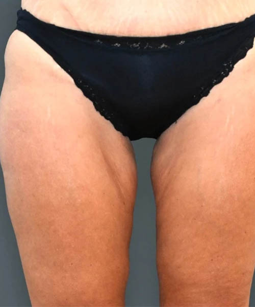 cryolipolysis - After Fat Freezing Before After