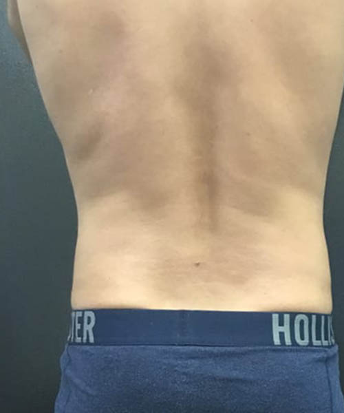 cryolipolysis - After Fat Freezing Before After