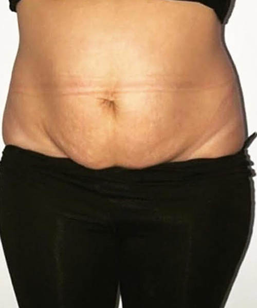 cryolipolysis - Before Fat Freezing Before After