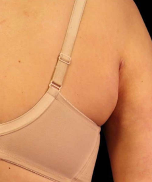 cryolipolysis - Before Fat Freezing Before After