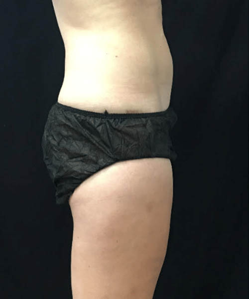 cryolipolysis - Before Fat Freezing Before After