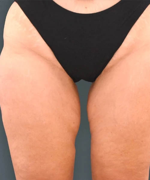 cryolipolysis - Before Fat Freezing Before After