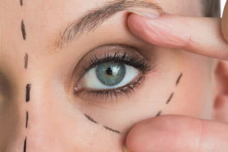 Blepharoplasty Soft Surgery