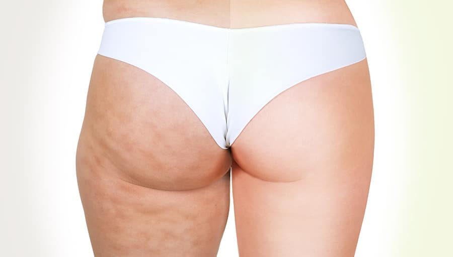Cellulite Reduction - Before and After