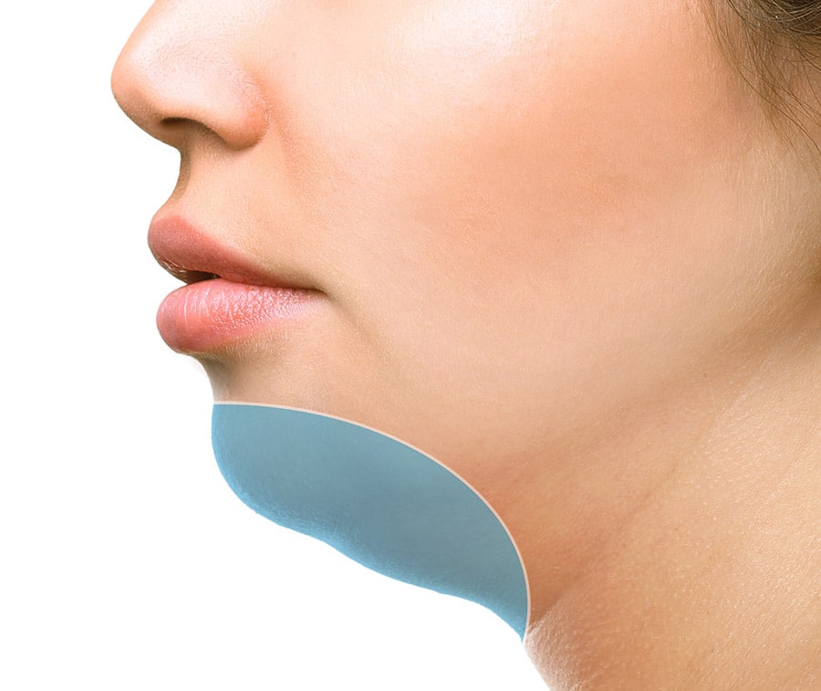 Area treated by Double Chin Reduction
