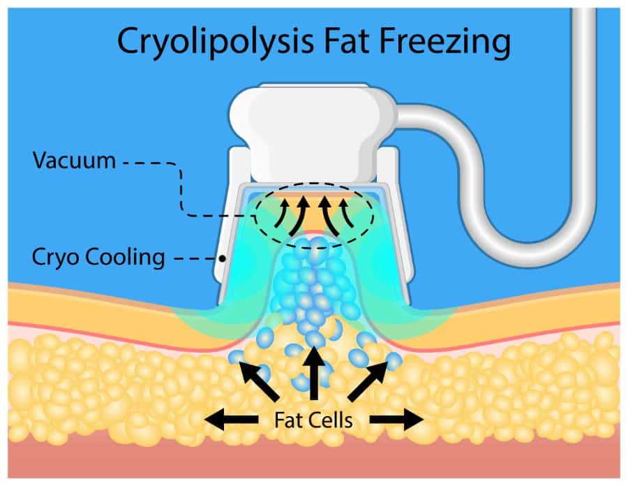 Cryolipolysis Illustration