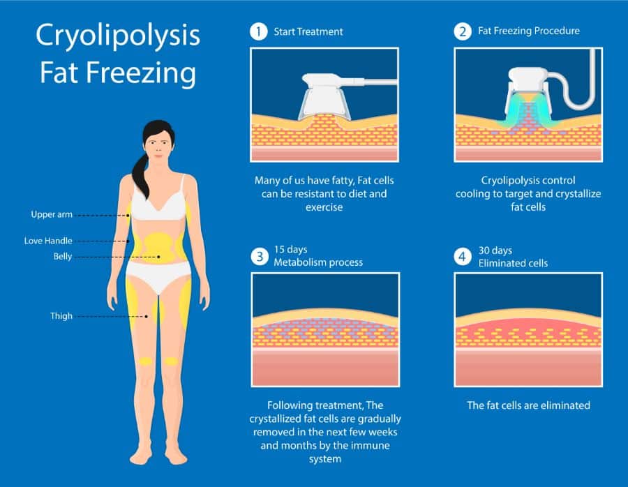 llustration describing the steps of fat freezing treatment