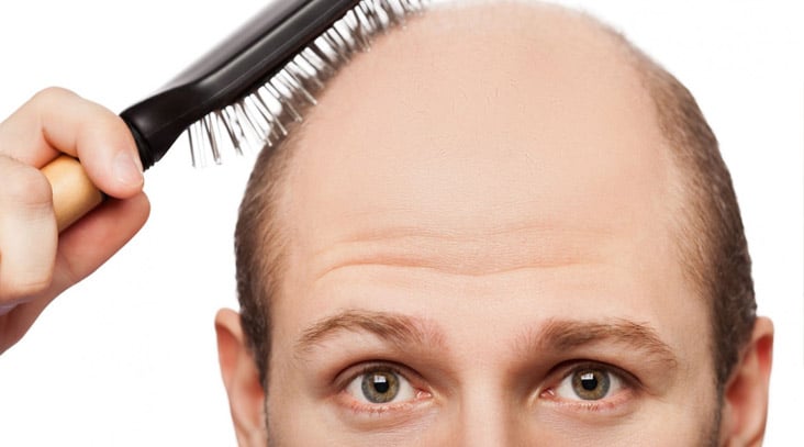 Natural Remedies to Stop Hair Loss - VIVO Clinic