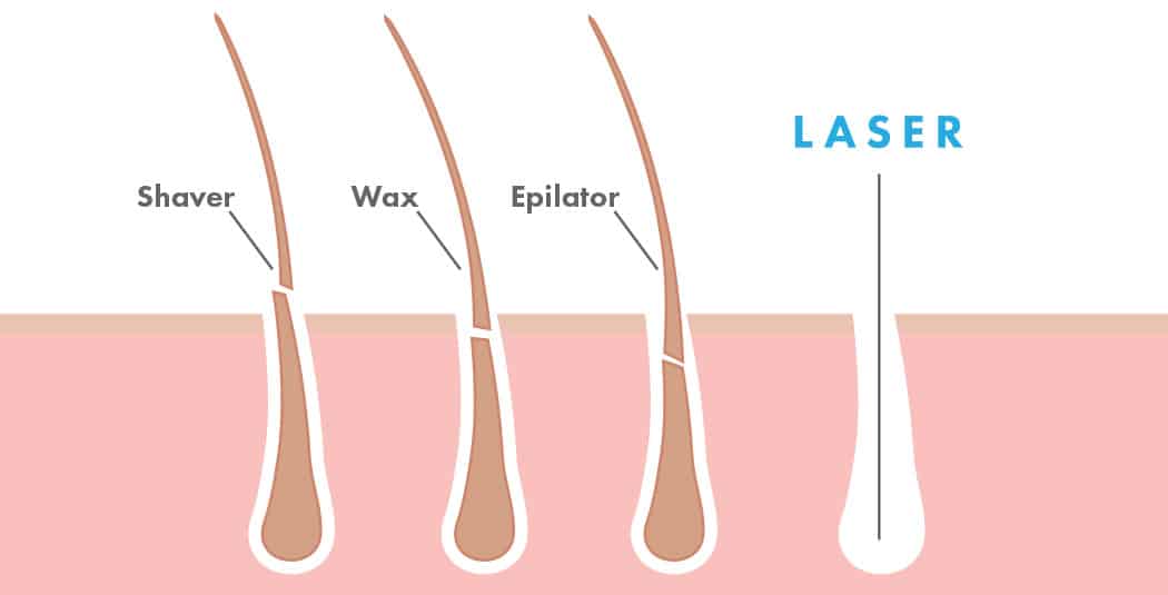 Hair Removal Effectiveness