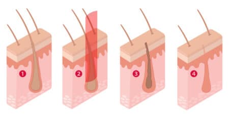 Hair Removal Process