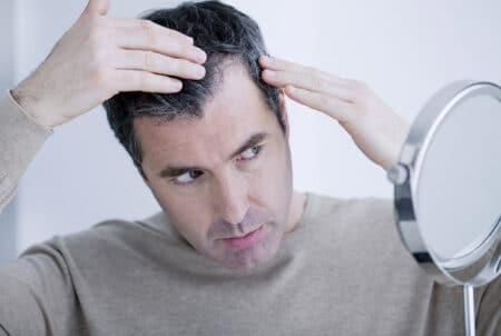 Male Hair Loss