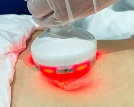 RF Tummy Tightening