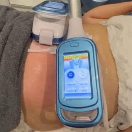 Cryolipolysis Fat Freezing Treatment