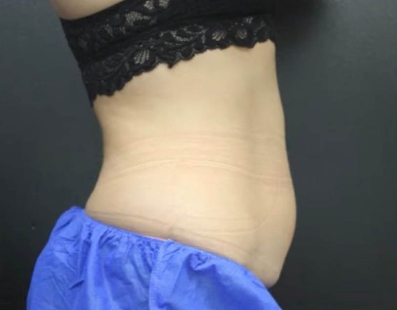 Radio Frequency Tummy Tightening - VIVO Clinic