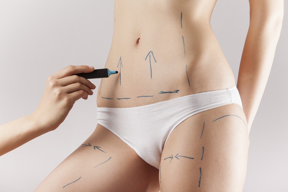 Marked Body Areas for Cryolipolysis