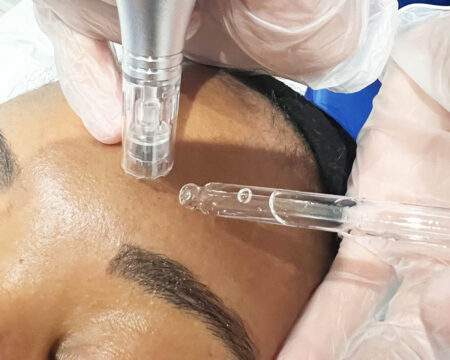 Microneedling