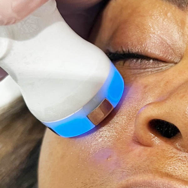 Radiofrequency Facial Skin Lift