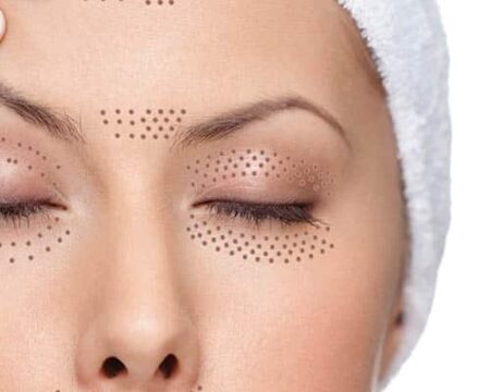 Plasma Eye Lift London, plasma eye lift Newcastle