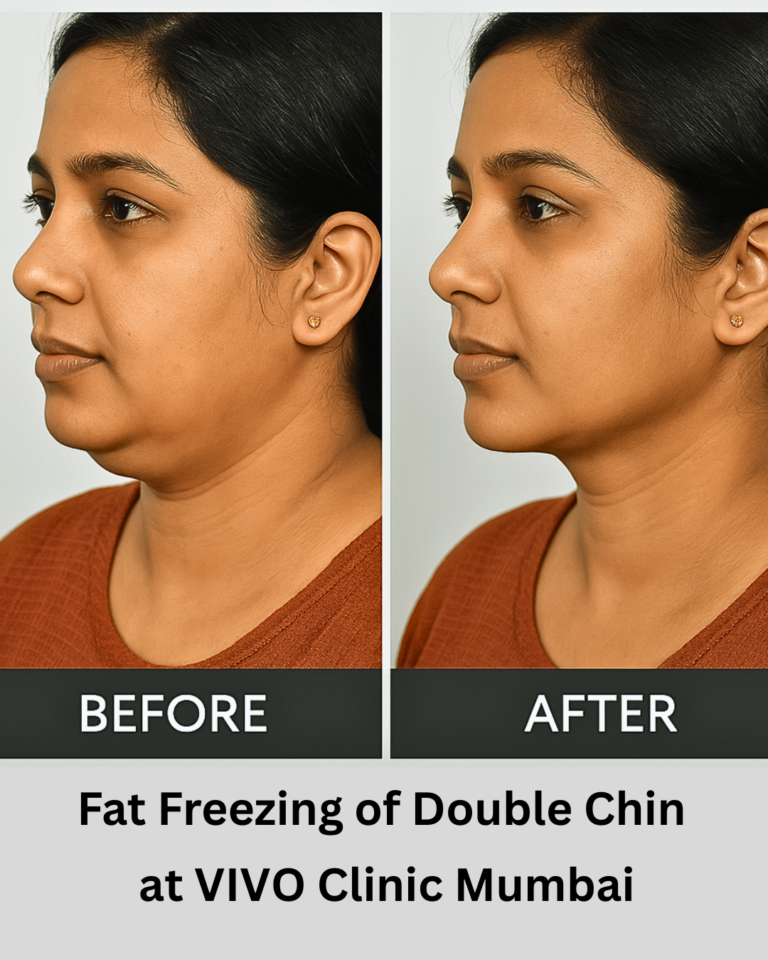fat freezing double chin
