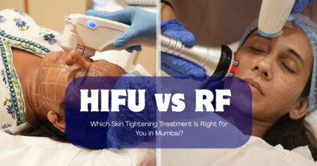 HIFU vs RF: Which Skin Tightening Treatment Is Right for You in Mumbai? 7 hifu vs rf skin tightening, rf vs hifu, hifu treatment mumbai, rf skin tightening treatment, Hifu Vs Rf Skin Tightening