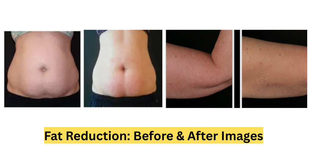 Fat Reduction